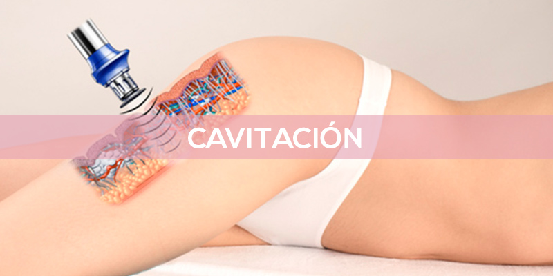 cavitacion